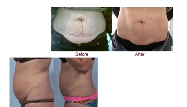 4 Handles Coolsculpting Machine