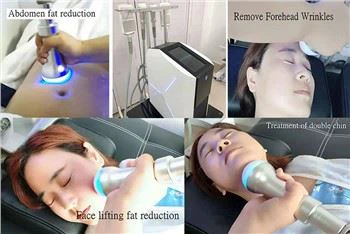 Kelebihan Unik Mesin Cryoskin Terlaris Amerika