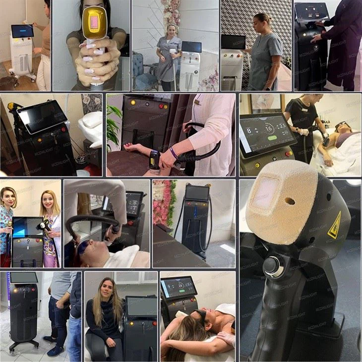 Best Selling Diode Laser Hair Removal Machine in Europe